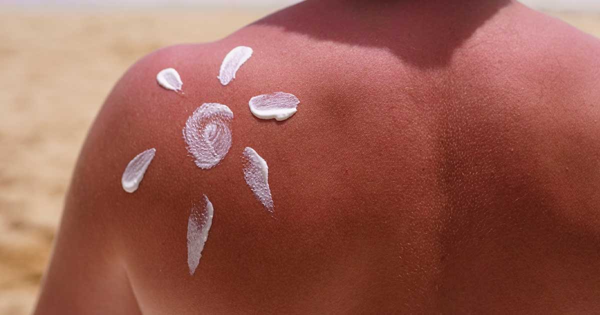 Aplicarea cremei de protecție solară pe piele, prevenirea cancerului de piele, vara 2026
